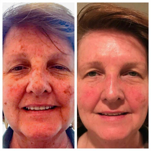 Skin Care Results